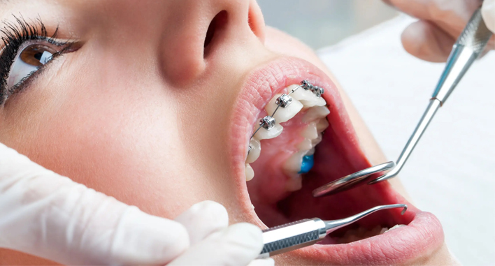 Best Orthodontist in Vesu
