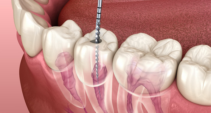 Root Canal Treatment In Vesu