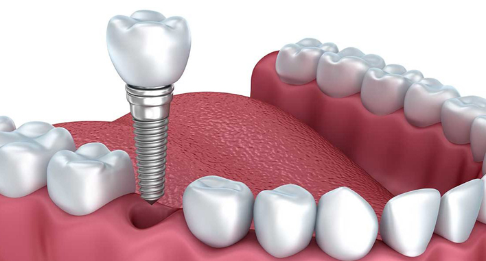 Dental implants in Surat