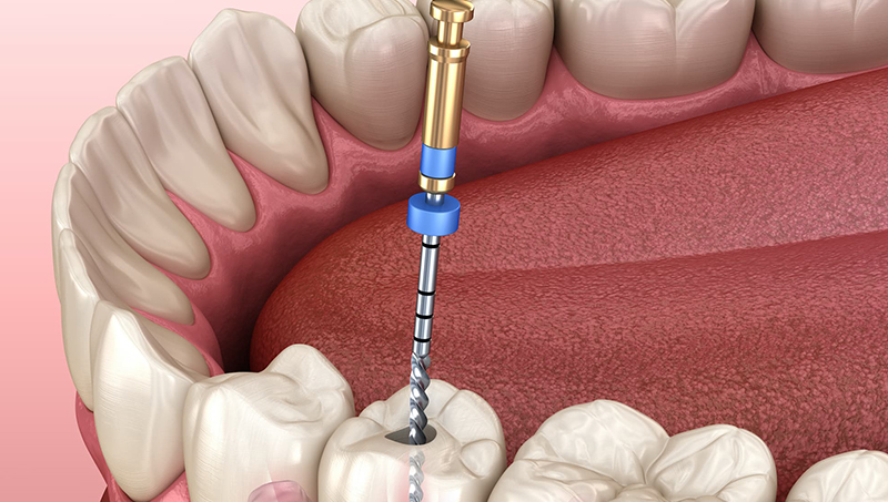 Best Root Canal Treatment in Surat