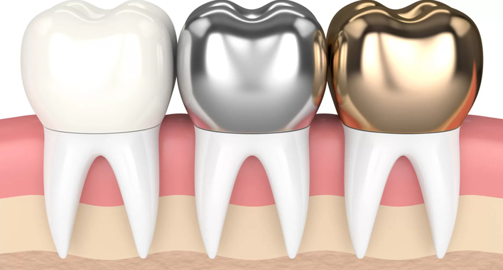 Dental Crowns In Vesu