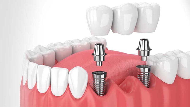 5 Important Reasons Dental Implants are beneficial to your health