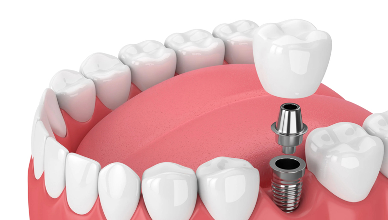 Dental Implants In Vesu