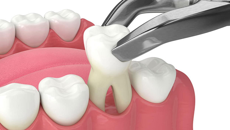 Things to avoid after your dental treatment