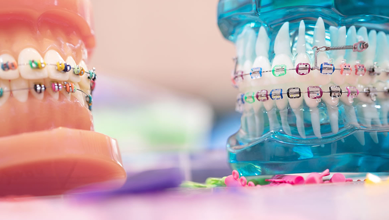 Best Orthodontist in Surat