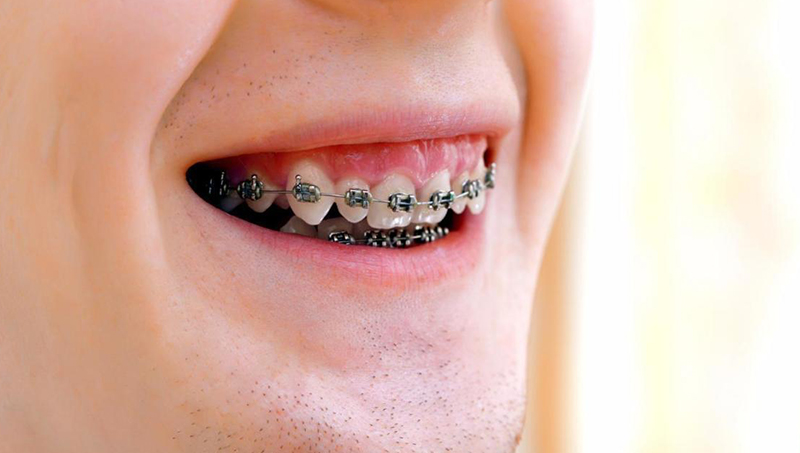 Myths in dentistry regarding braces
