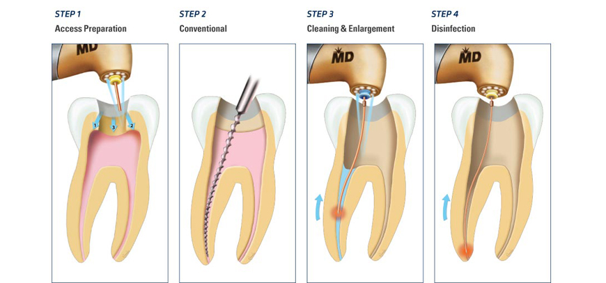 Laser Assisted Root Canal Therapy