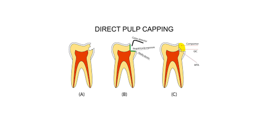 Pulpcapping / Pulpotomy