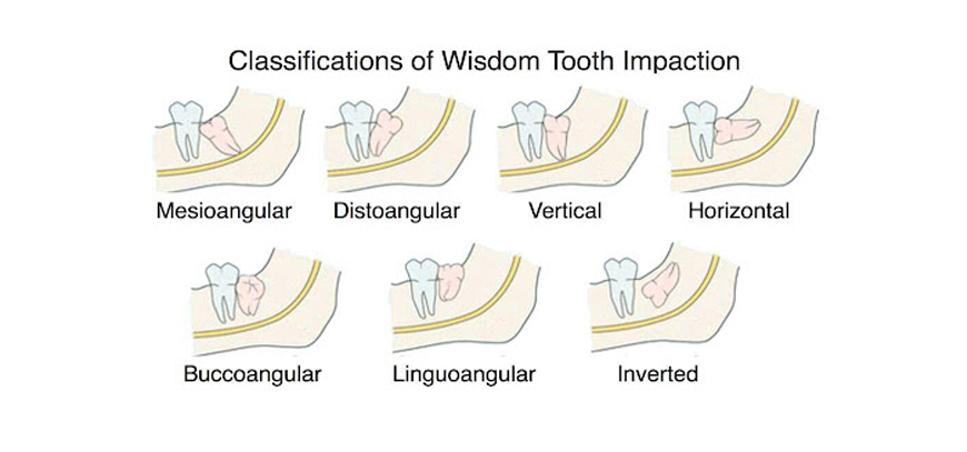 Disimpaction Of Wisdom Teeth