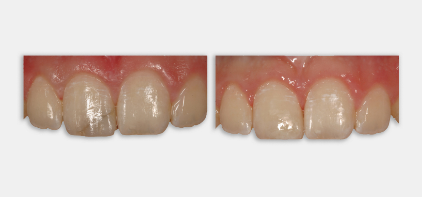 Direct / Indirect Restorations