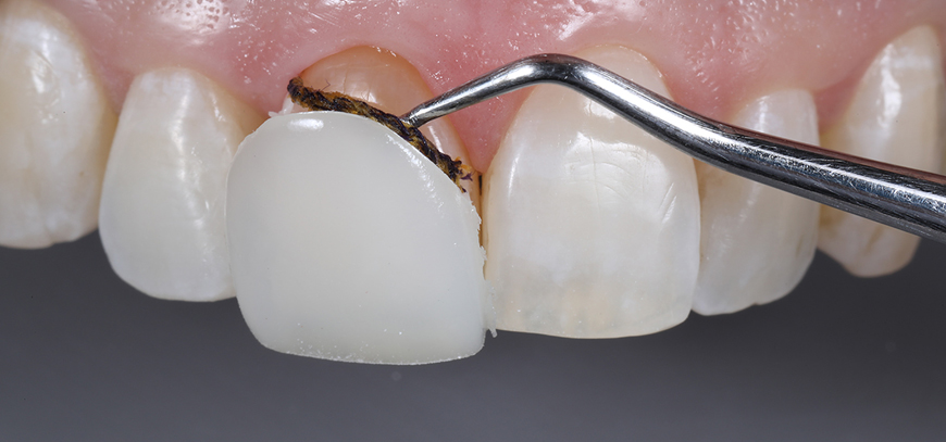 Direct And Indirect Veneers