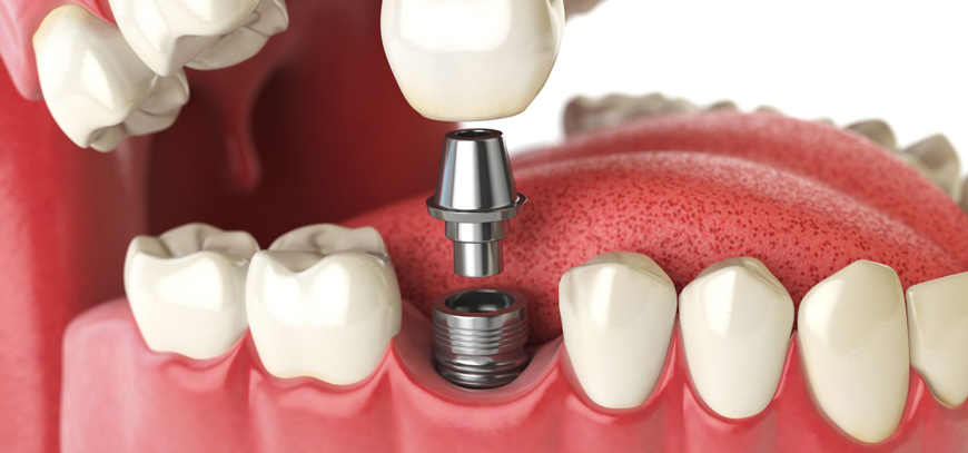 Implant Exposure