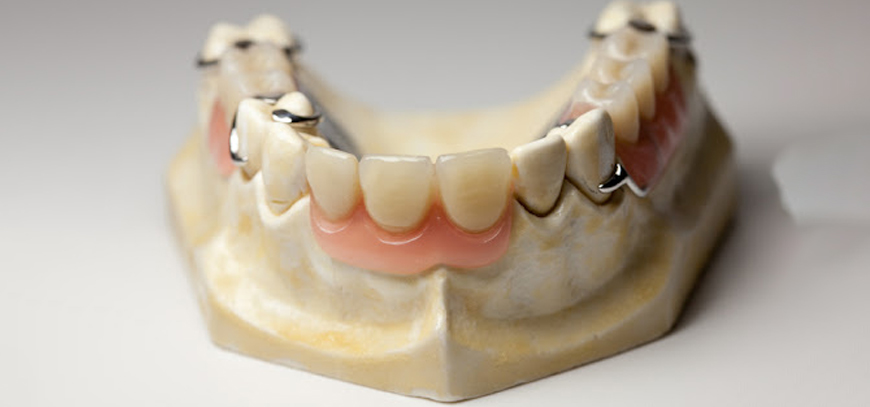 Cast Partial Dentures