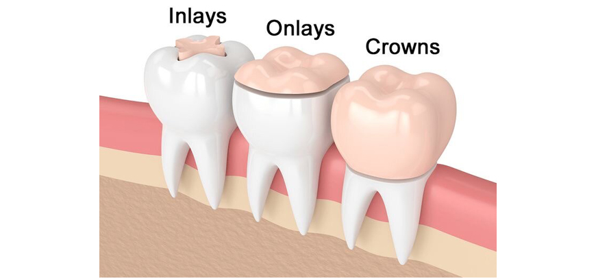 Inlay-Onlay Restorations