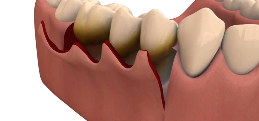 Flap Surgery