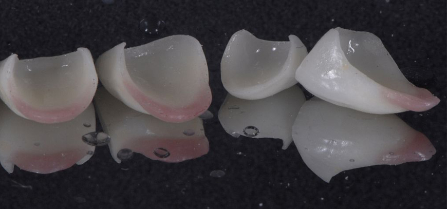 Ceramic Veneers
