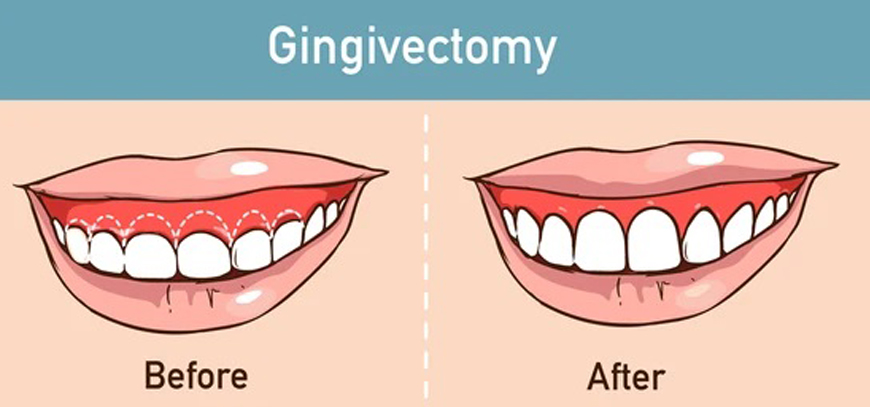 Gingivectomy