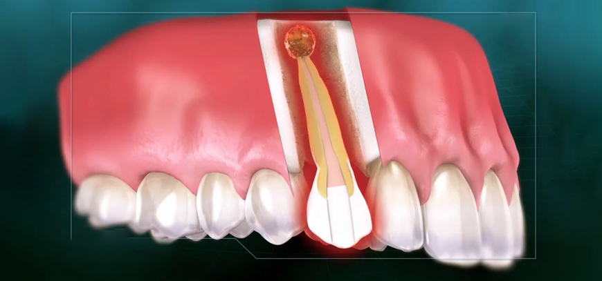 Apicoectomy and Cyst Enucleation
