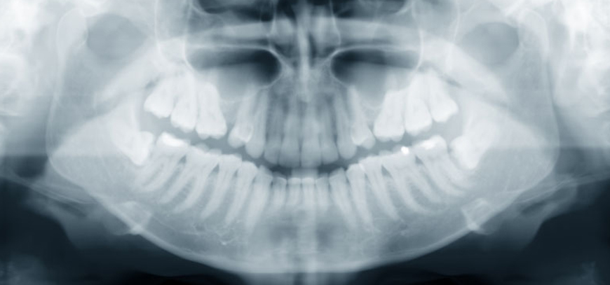 Frenectomy