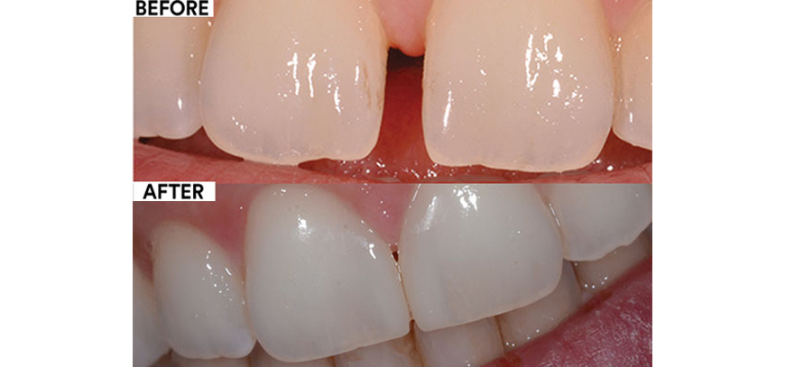 Diastema Closure