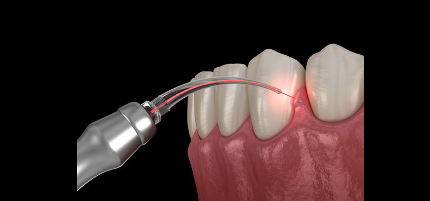 Depigmentation Of Gums