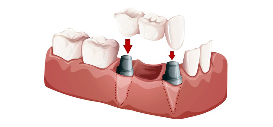 Crowns And Bridges