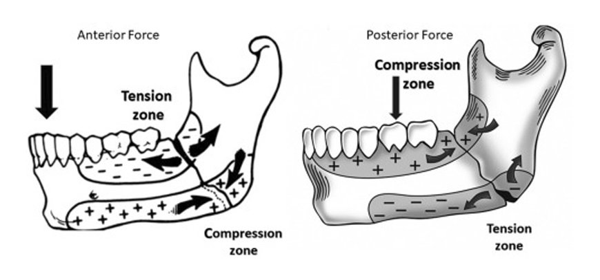 Treatment Of Jaw Fractures
