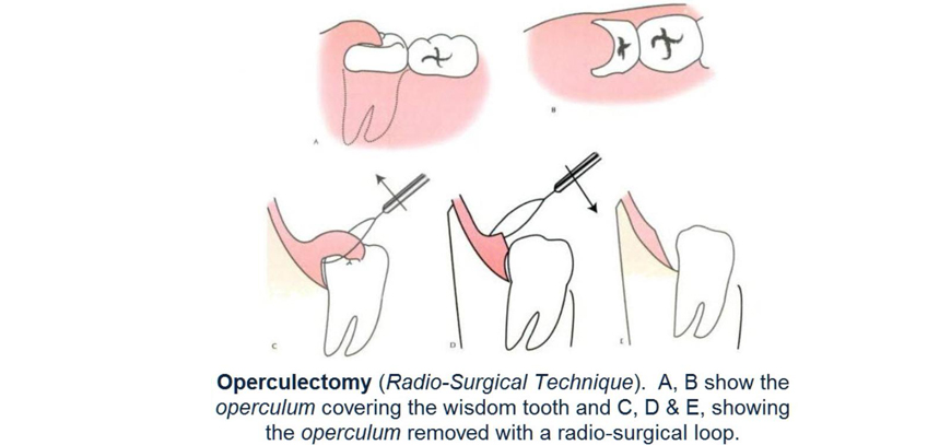 Operculectomy