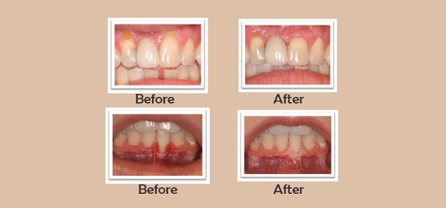 Periodontics Plastic Surgery