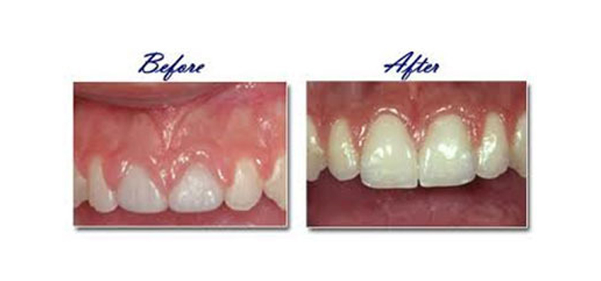 Gingivoplasty