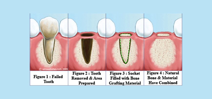 Bone Grafting Procedures