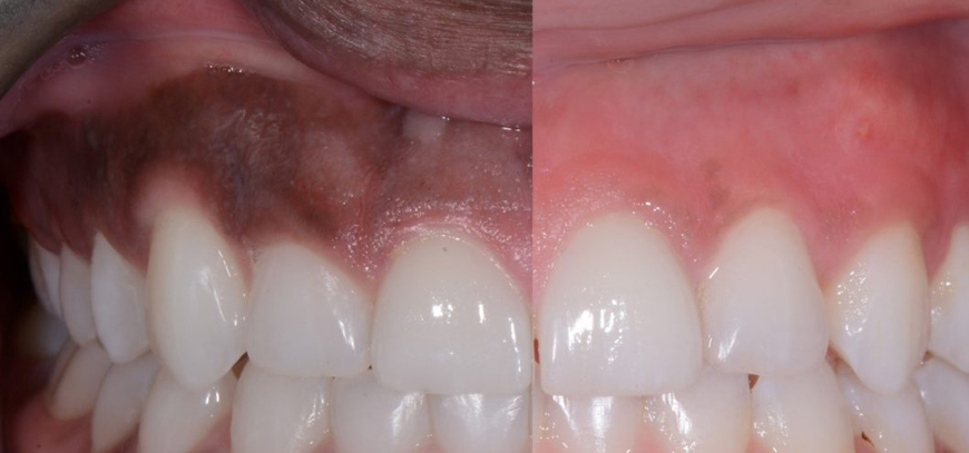 Laser Depigmentation Of Gums