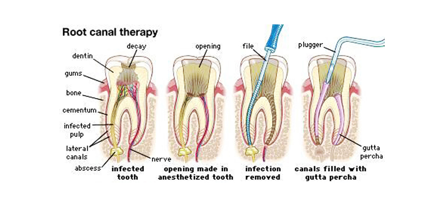 Multi-Rooted Root Canal Therapy