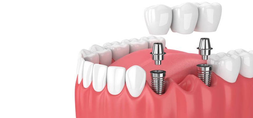Single Tooth Implants